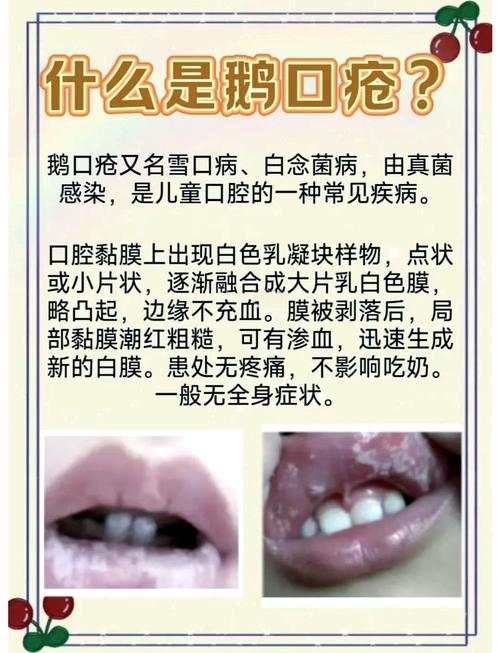 新生儿鹅口疮反复发作怎么办?日常护理有哪些关键点?-第2张图片-郑州医学网 新生儿鹅口疮反复发作怎么办?日常护理有哪些关键点?-第2张图片-郑州医学网