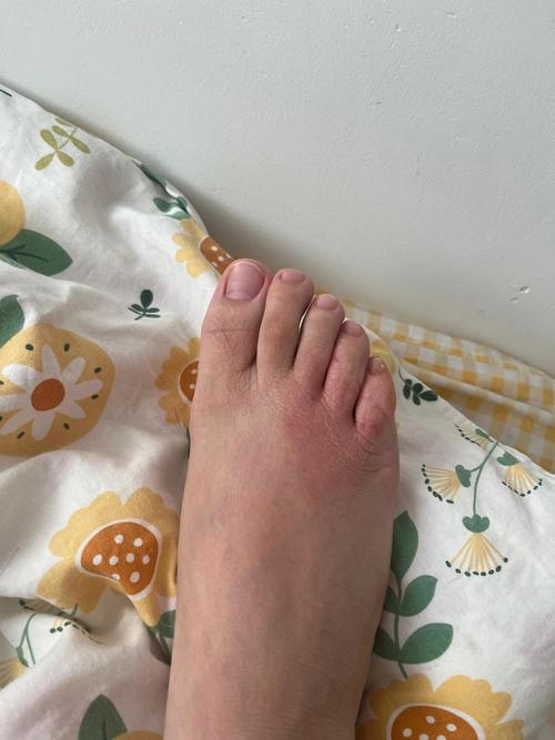 怀孕期间脚上突然长红点点，是孕期正常现象还是身体发出的健康警报？-第1张图片-郑州医学网