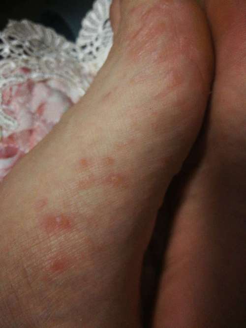 怀孕期间脚上突然长红点点，是孕期正常现象还是身体发出的健康警报？-第2张图片-郑州医学网