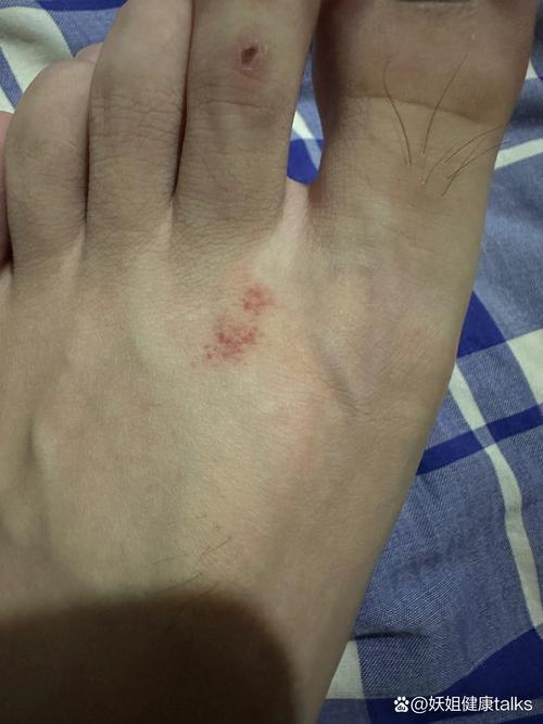 怀孕期间脚上突然长红点点，是孕期正常现象还是身体发出的健康警报？-第3张图片-郑州医学网