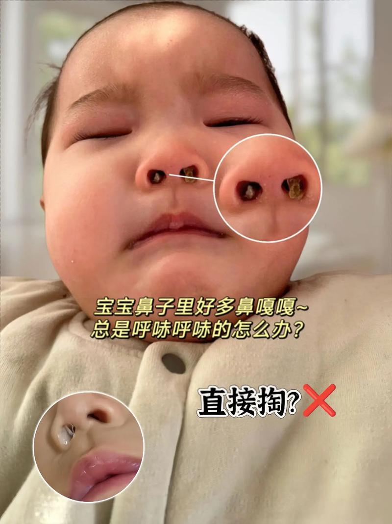 新生儿鼻子横纹图片是正常现象吗？需要担心健康问题吗？-第2张图片-郑州医学网