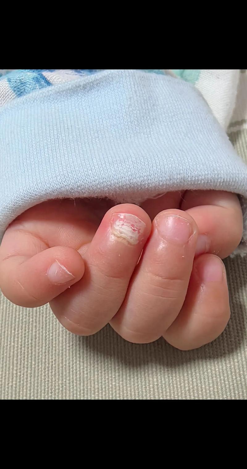 儿童指甲真菌感染图片有哪些典型症状?如何判断是否需要就医治疗?-第1张图片-郑州医学网 儿童指甲真菌感染图片有哪些典型症状?如何判断是否需要就医治疗?-第1张图片-郑州医学网