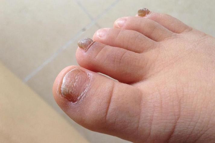 儿童指甲真菌感染图片有哪些典型症状?如何判断是否需要就医治疗?-第2张图片-郑州医学网 儿童指甲真菌感染图片有哪些典型症状?如何判断是否需要就医治疗?-第2张图片-郑州医学网