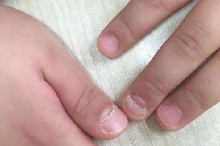 儿童指甲真菌感染图片有哪些典型症状?如何判断是否需要就医治疗?-第3张图片-郑州医学网 儿童指甲真菌感染图片有哪些典型症状?如何判断是否需要就医治疗?-第3张图片-郑州医学网