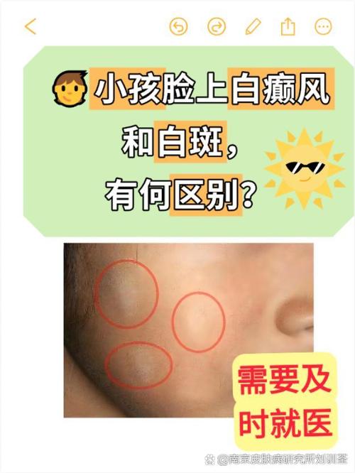 儿童脸上有白斑是缺钙还是白癜风？这些原因家长必须警惕！-第1张图片-郑州医学网