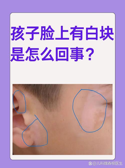 儿童脸上有白斑是缺钙还是白癜风？这些原因家长必须警惕！-第3张图片-郑州医学网