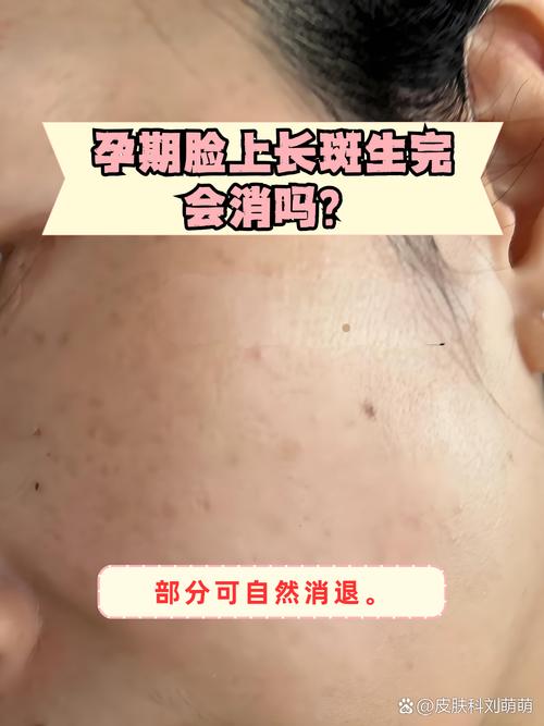 怀孕期间长斑能安全消除吗？对胎儿有影响吗？-第2张图片-郑州医学网