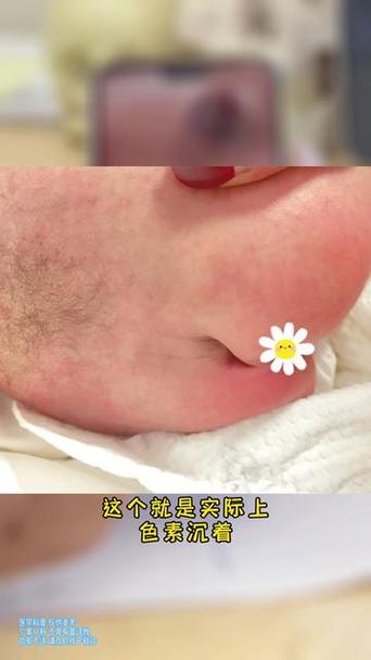 新生儿皮毛窦骶尾部该如何早期识别与干预？-第1张图片-郑州医学网