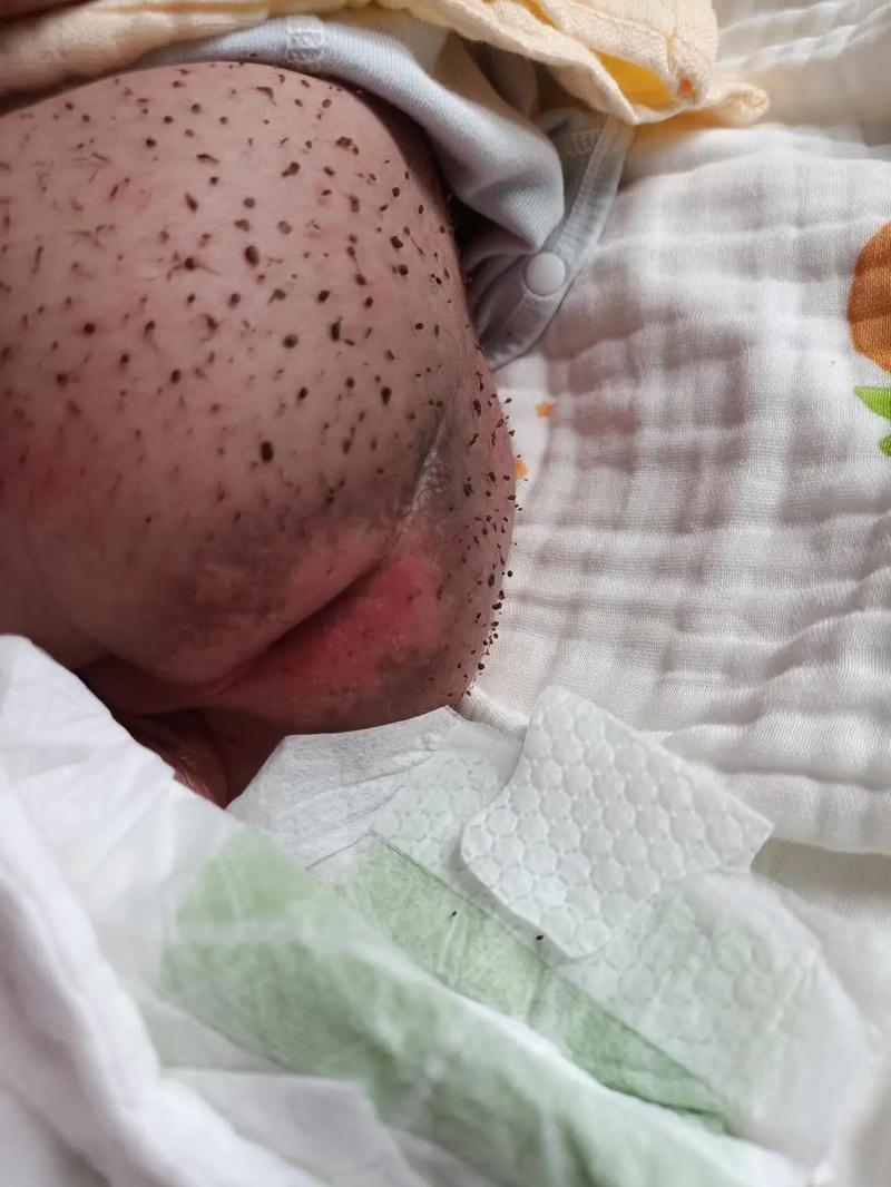 新生儿皮毛窦骶尾部该如何早期识别与干预？-第3张图片-郑州医学网