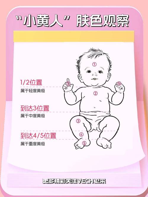 新生儿黄疸快速消退有哪些科学有效的方法？-第3张图片-郑州医学网