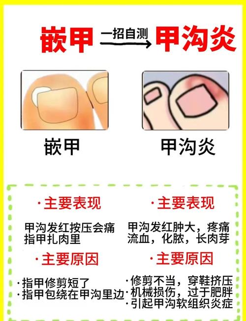 怀孕期间甲沟炎反复发作，对胎儿有影响吗？该怎么安全处理？-第1张图片-郑州医学网