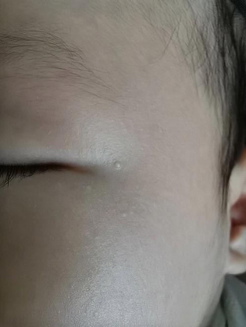新生儿眼角白色东西是眼屎还是其他眼部问题?-第1张图片-郑州医学网 新生儿眼角白色东西是眼屎还是其他眼部问题?-第1张图片-郑州医学网