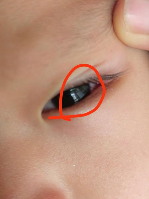 新生儿眼角白色东西是眼屎还是其他眼部问题?-第3张图片-郑州医学网 新生儿眼角白色东西是眼屎还是其他眼部问题?-第3张图片-郑州医学网
