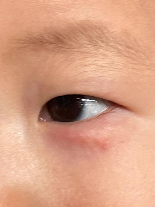 新生儿眼角白色东西是眼屎还是其他眼部问题？-第2张图片-郑州医学网