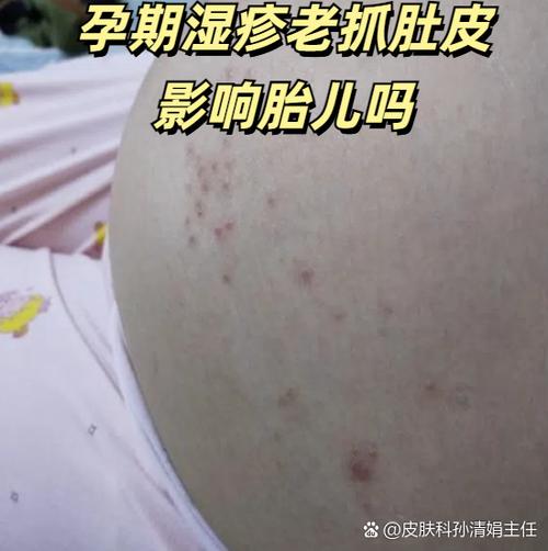 怀孕期间为何总被湿疹缠上?孕期湿疹的诱因与应对方法有哪些?-第1张图片-郑州医学网 怀孕期间为何总被湿疹缠上?孕期湿疹的诱因与应对方法有哪些?-第1张图片-郑州医学网