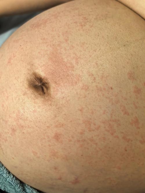 怀孕期间为何总被湿疹缠上？孕期湿疹的诱因与应对方法有哪些？-第3张图片-郑州医学网