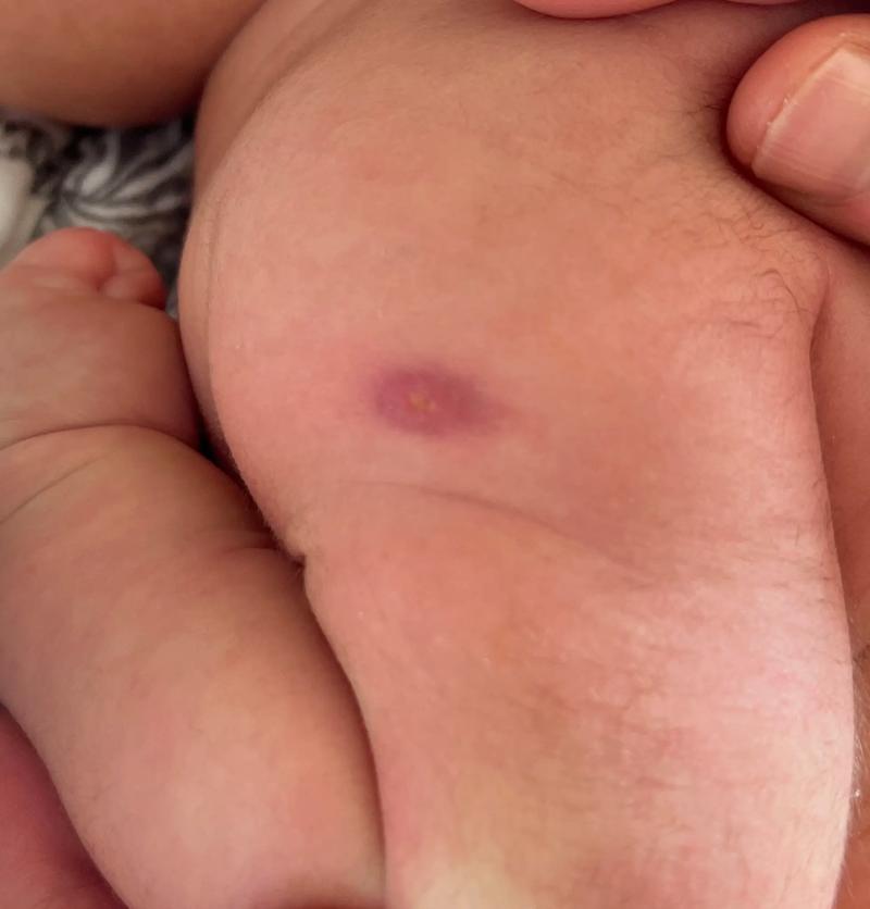 新生儿小鸡头红肿图片显示异常情况，需要警惕哪些潜在健康问题？-第2张图片-郑州医学网