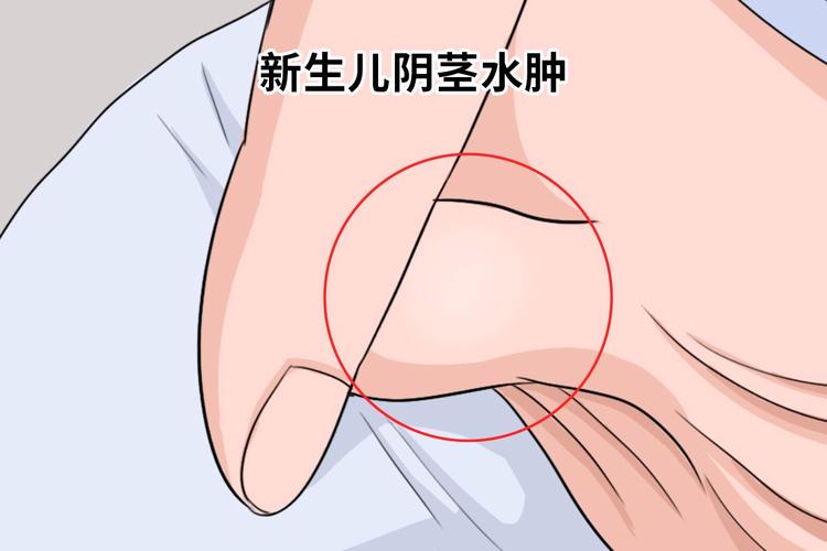新生儿小鸡头红肿图片显示异常情况，需要警惕哪些潜在健康问题？-第1张图片-郑州医学网
