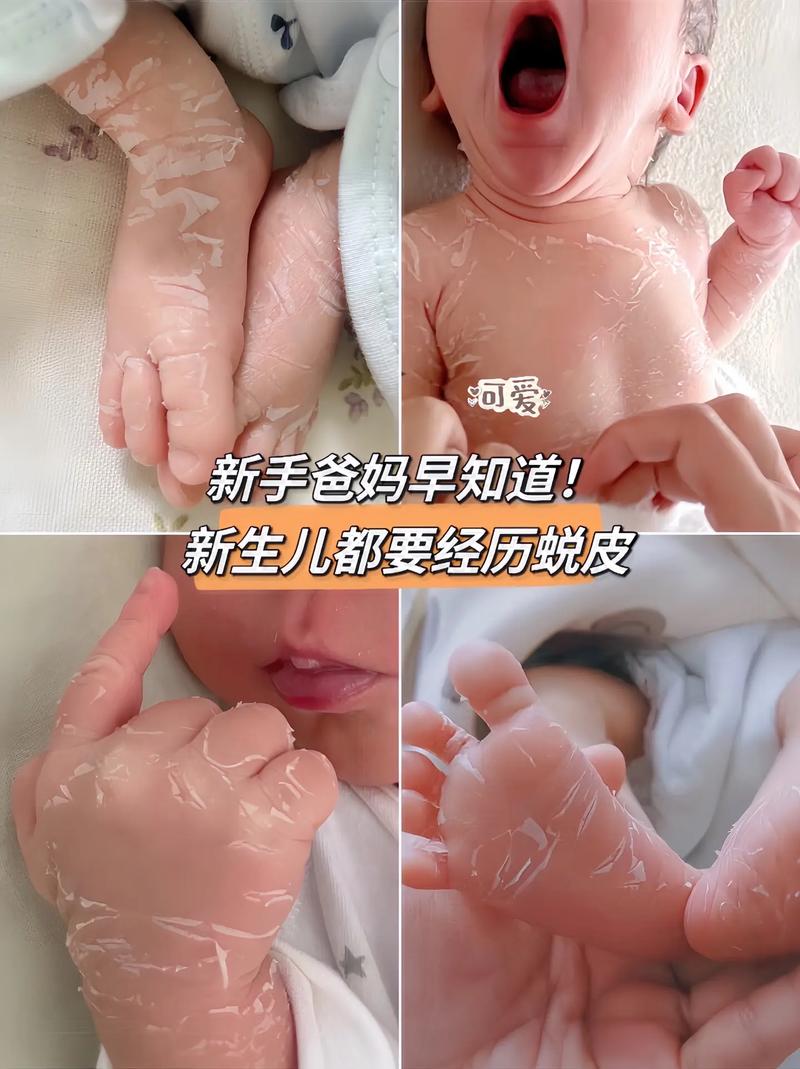 新生儿脱皮期间到底能不能洗澡？正确的清洁护理方法是什么？-第1张图片-郑州医学网