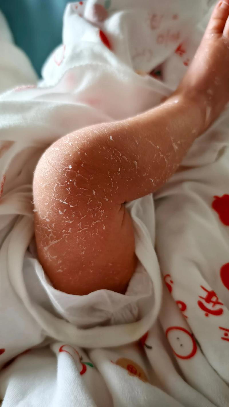 新生儿脱皮期间到底能不能洗澡？正确的清洁护理方法是什么？-第2张图片-郑州医学网