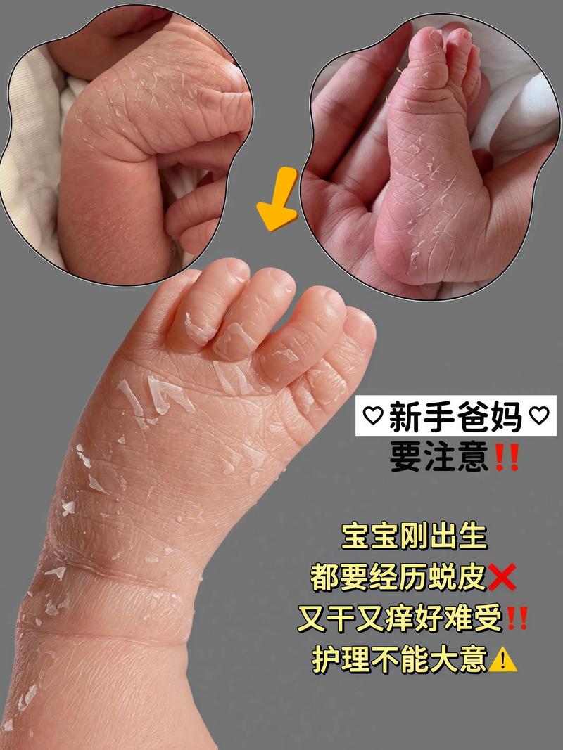 新生儿脱皮期间到底能不能洗澡？正确的清洁护理方法是什么？-第3张图片-郑州医学网