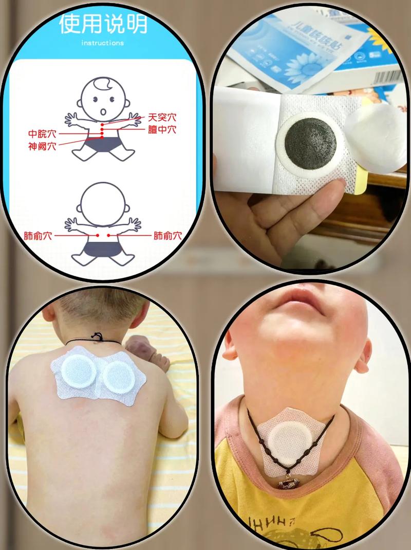 儿童贴止咳贴的位置图，不同年龄段穴位有差异吗？-第2张图片-郑州医学网