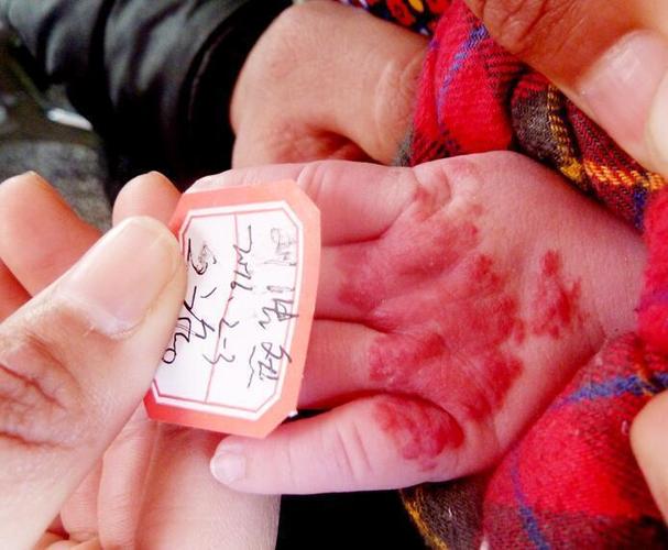 新生儿手上的红色斑块是正常现象还是疾病信号？需要担心吗？-第1张图片-郑州医学网