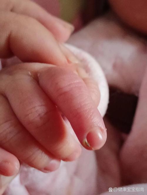 新生儿手上的红色斑块是正常现象还是疾病信号？需要担心吗？-第2张图片-郑州医学网