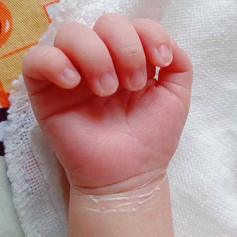 新生儿手上的红色斑块是正常现象还是疾病信号？需要担心吗？-第3张图片-郑州医学网