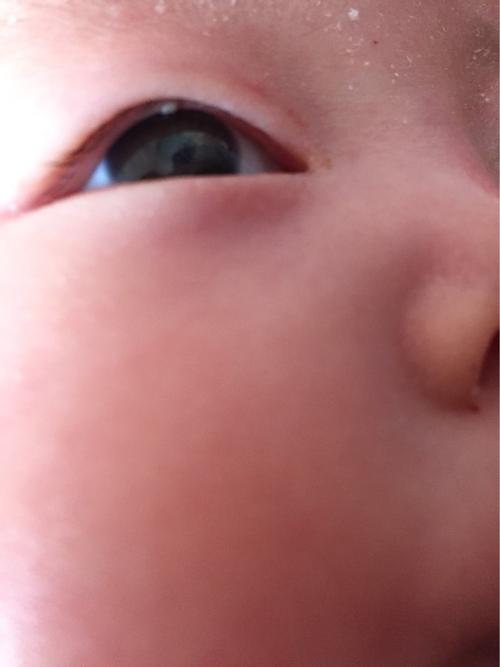 新生儿眼角出现白色泡泡是正常现象还是疾病信号？-第3张图片-郑州医学网