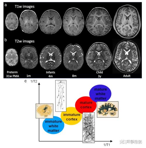 新生儿做磁共振检查存在哪些潜在危害？-第2张图片-郑州医学网