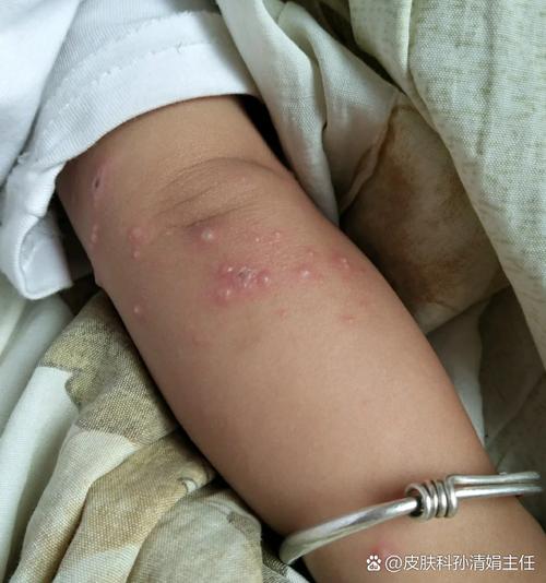 新生儿黄水泡症状图片是什么样的？需要警惕哪些疾病风险？-第1张图片-郑州医学网