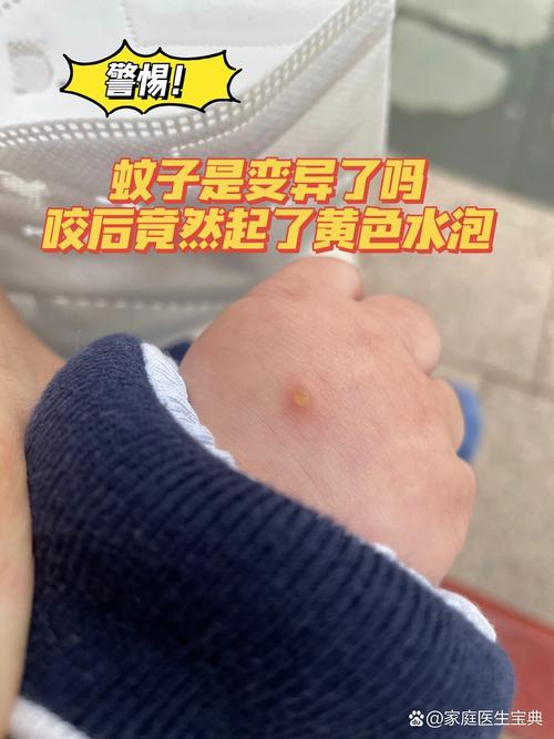 新生儿黄水泡症状图片是什么样的？需要警惕哪些疾病风险？-第2张图片-郑州医学网