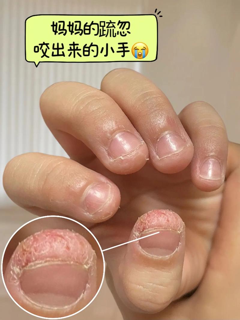 儿童频繁吃手指是生理需求还是心理问题？背后隐藏着哪些成长信号？-第2张图片-郑州医学网