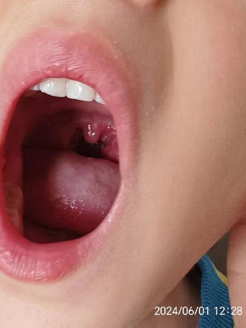 儿童嗓子红和不红图片对比，如何通过症状区分普通感冒与链球菌感染？-第1张图片-郑州医学网