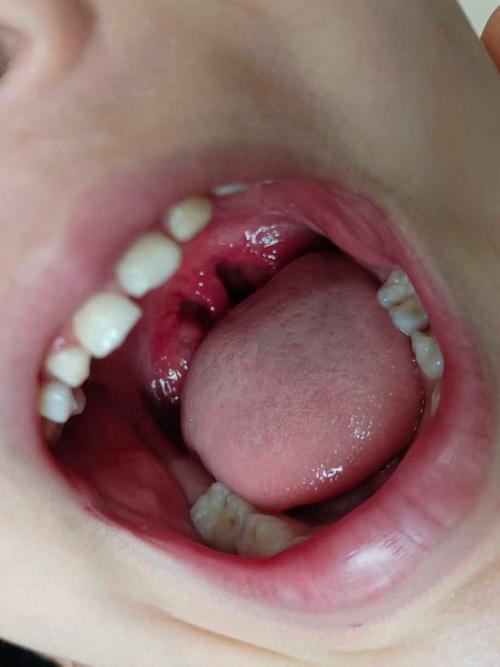 儿童嗓子红和不红图片对比，如何通过症状区分普通感冒与链球菌感染？-第2张图片-郑州医学网