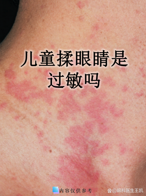 孩子频繁揉眼睛是生病了吗？揉眼背后藏着哪些健康隐患？-第3张图片-郑州医学网