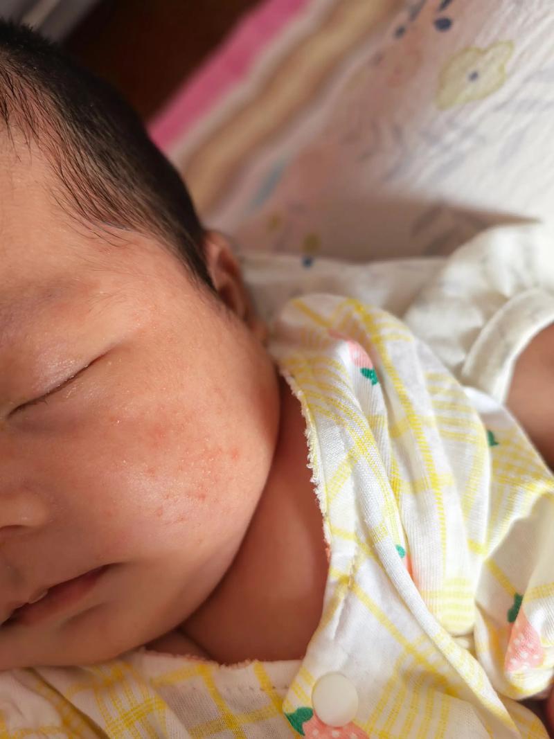 新生儿脸上湿疹到底能不能自愈？家长需要做些什么来帮助缓解呢？-第1张图片-郑州医学网