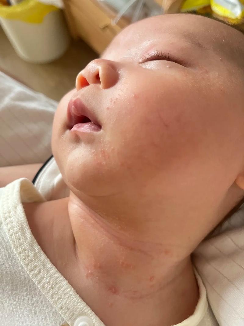 新生儿脸上湿疹到底能不能自愈？家长需要做些什么来帮助缓解呢？-第2张图片-郑州医学网