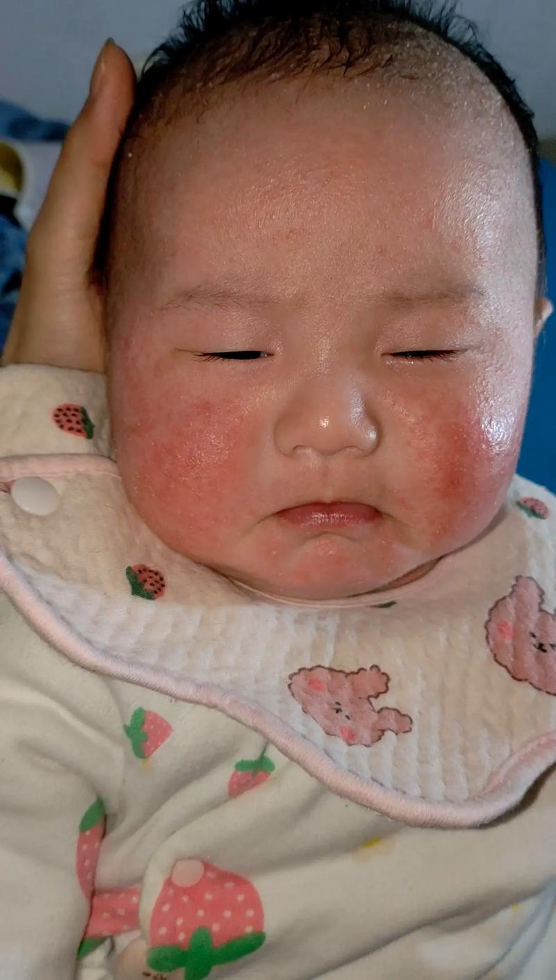新生儿脸上湿疹到底能不能自愈？家长需要做些什么来帮助缓解呢？-第3张图片-郑州医学网