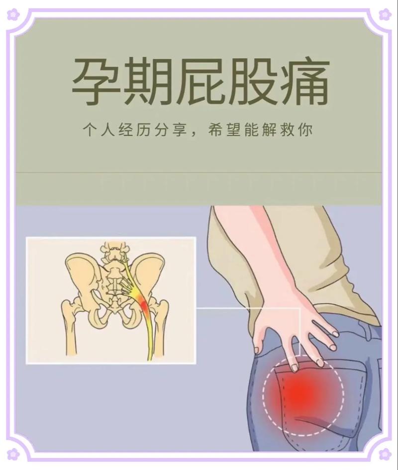 孕期左侧屁股痛是压迫神经还是缺钙？怎么缓解才安全？-第1张图片-郑州医学网