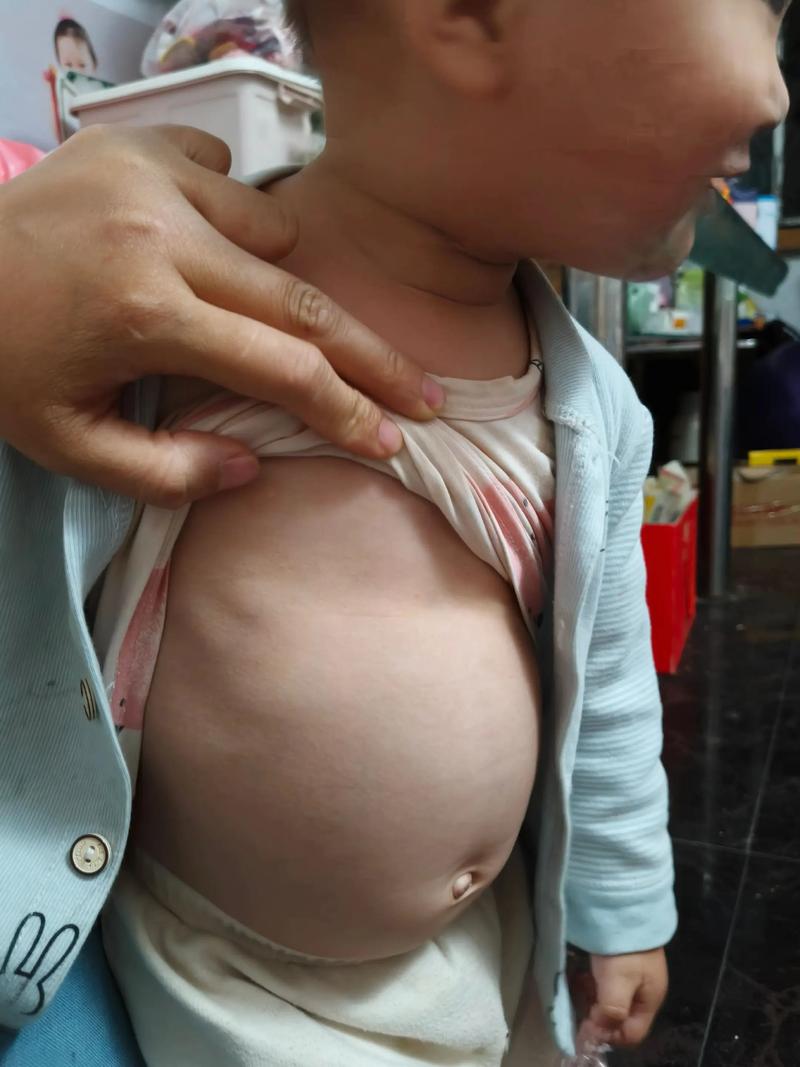 新生儿肚子青筋明显是正常现象吗？图片显示这种情况需要担心吗？-第2张图片-郑州医学网