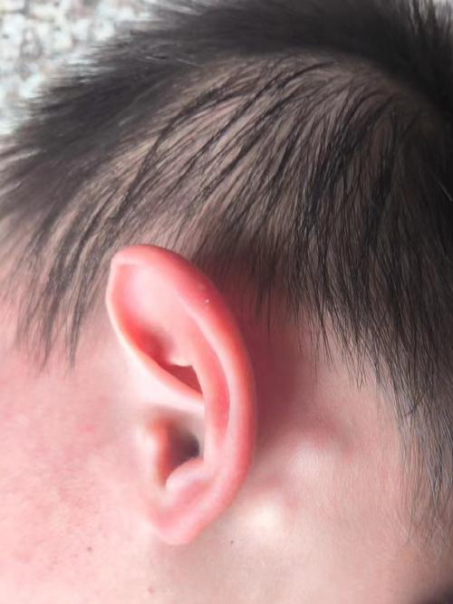 儿童耳后淋巴结肿大图，正常与异常的界限在哪里？需警惕哪些疾病信号？-第2张图片-郑州医学网