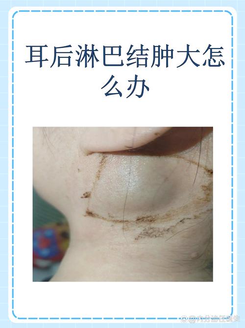 儿童耳后淋巴结肿大图，正常与异常的界限在哪里？需警惕哪些疾病信号？-第3张图片-郑州医学网