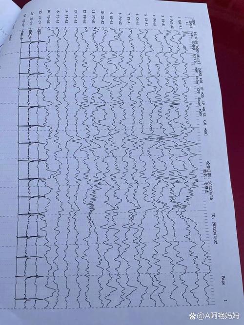儿童脑电图异常严重吗？是否需要立即就医？会对大脑发育有影响吗？-第2张图片-郑州医学网