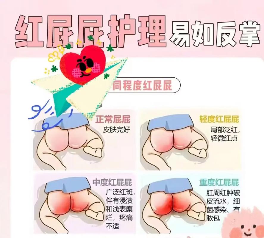 新生儿红屁股反反复复怎么办？如何有效护理才能快速好？-第1张图片-郑州医学网