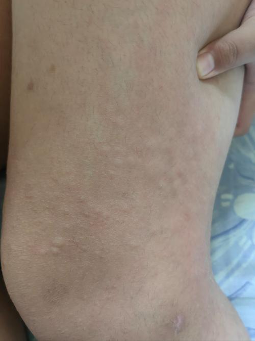 儿童过敏身上起红疙瘩，是哪些因素导致的？如何有效缓解？-第1张图片-郑州医学网