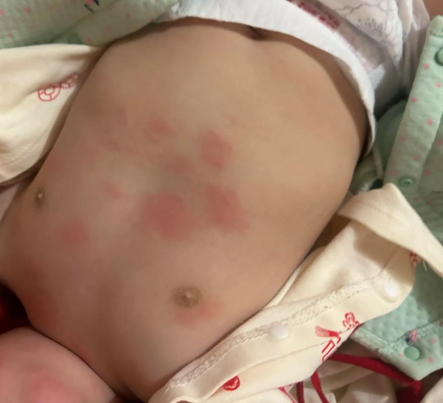 儿童过敏身上起红疙瘩，是哪些因素导致的？如何有效缓解？-第2张图片-郑州医学网