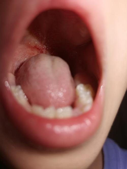 儿童链球菌感染严重吗-第2张图片-郑州医学网