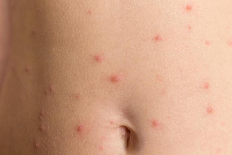 儿童水痘初期症状图片有哪些典型表现？如何通过图片辨别早期水痘？-第2张图片-郑州医学网